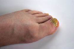 fungal nail infection